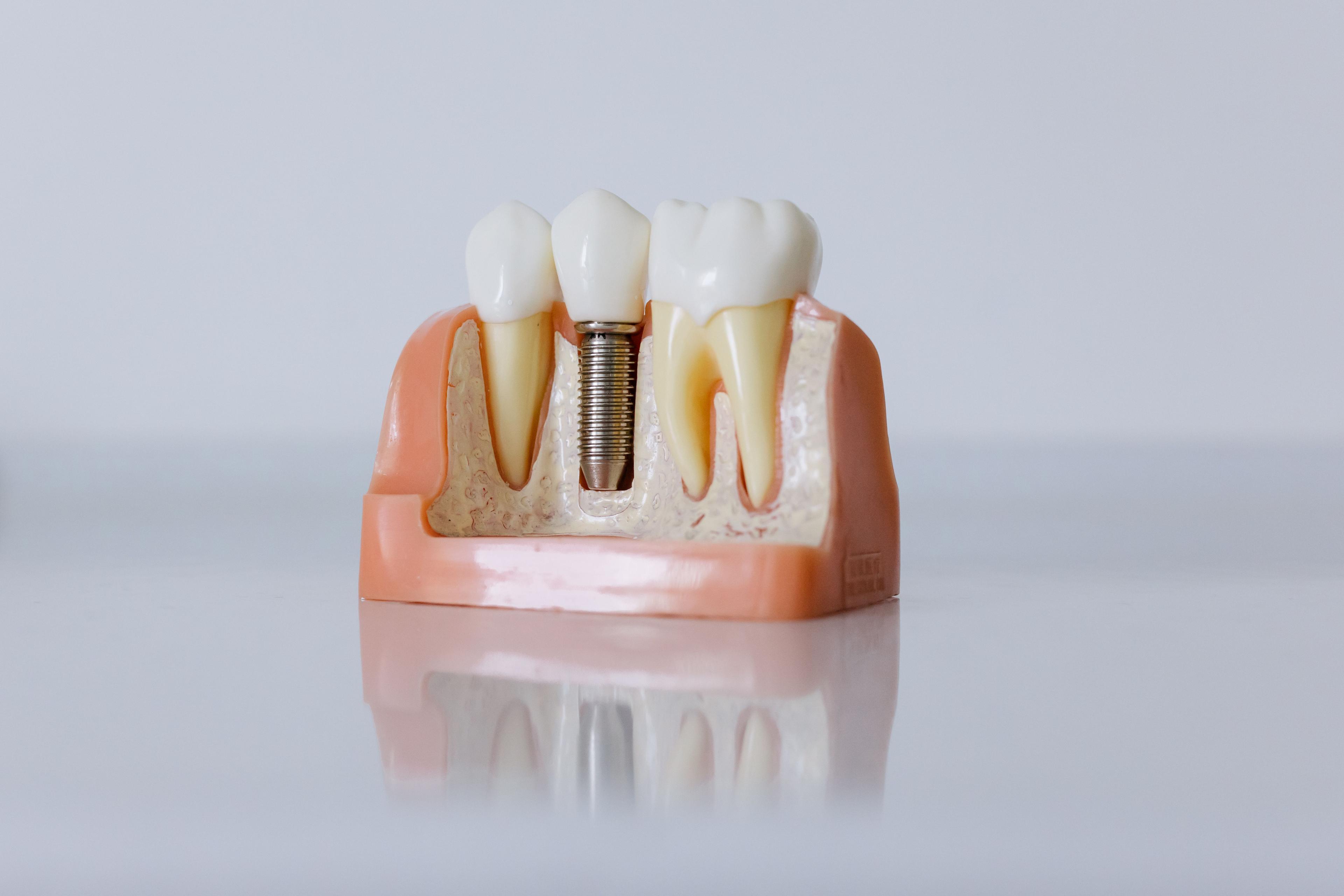 Implantacja natychmiastowa – na czym polega i dla kogo jest?