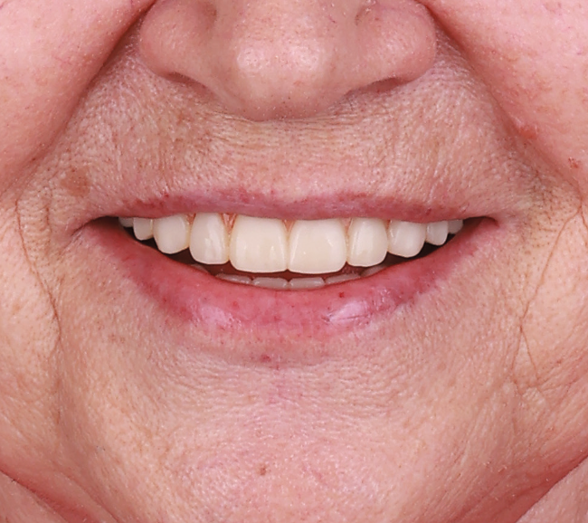 After treatment